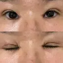 二重切開 / 目頭切開 EMMA CLINIC（エマクリニック） DAY 14 サムネイル用