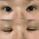 二重切開 / 目頭切開 EMMA CLINIC（エマクリニック） DAY 31 サムネイル用