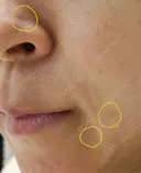 ほくろ・いぼ切除（肌） CLINIC W DAY 40 サムネイル用