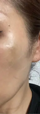 肌育注射（ジュベルックなど） / ジャルプロ LIFIX BEAUTY CLINIC DAY 3 サムネイル用