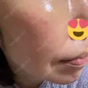 ジャルプロ ゆきスキンクリニック 東池袋 AFTER サムネイル用