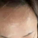 ボトックス（目尻） / ボトックス（額） / その他（目元） 共立美容外科 名古屋院 DAY 0 サムネイル用