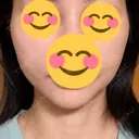 エレクトロポレーション / RF（高周波）たるみ治療 Days Beauty Clinic 新宿院 DAY 1 サムネイル用