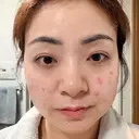 エレクトロポレーション / 光治療（フォトフェイシャルなど） トラスト美容クリニック 銀座院 AFTER サムネイル用