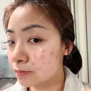 エレクトロポレーション / 光治療（フォトフェイシャルなど） トラスト美容クリニック 銀座院 DAY 1 サムネイル用