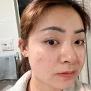エレクトロポレーション / 光治療（フォトフェイシャルなど） トラスト美容クリニック 銀座院 DAY 1 サムネイル用
