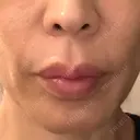 ソフウェーブ THE FIRST CLINIC 町田院 AFTER サムネイル用