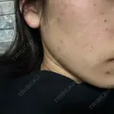 光治療（フォトフェイシャルなど） アクティブエイジクリニック DAY 2 サムネイル用