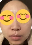 脂肪溶解注射（顔） 上野注入クリニック DAY 8 サムネイル用