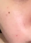 ピーリング（ハリ・ツヤ） ジュエルクリニック 恵比寿院 DAY 0 サムネイル用