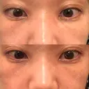 下まぶたたるみ取り セオリークリニック DAY 10 サムネイル用