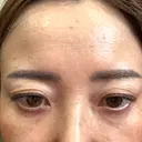 ボトックス（目尻） / 肌育注射（ジュベルックなど） ルラ美容クリニック 郡山院 DAY 6 サムネイル用