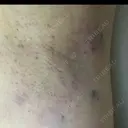 ワキ汗治療（レーザー） Fellez Clinic【フェルズクリニック】 AFTER サムネイル用