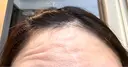 ボトックス（エラ・小顔） / ボトックス（口角） / ボトックス（肩） / ボトックス（眉間） / ボトックス（額） / ボトックス（人中） メディカルアルファクリニック DAY 0 サムネイル用