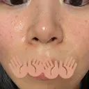 ニキビ治療 / 美肌レーザー ウィルビークリニック 新宿院 DAY 1 サムネイル用