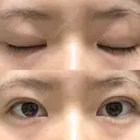 二重埋没 / 上まぶたの脂肪取り アリエル美容クリニック 郡山院 DAY 63 サムネイル用