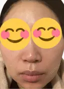 脂肪溶解注射（顔） 上野注入クリニック AFTER サムネイル用