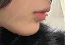 その他（鼻） / その他（輪郭） / その他 ルラ美容クリニック 大阪本院 DAY 0 サムネイル用
