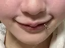 その他（鼻） / その他（輪郭） / その他 ルラ美容クリニック 大阪本院 DAY 0 サムネイル用