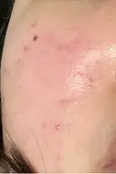 ピーリング（ハリ・ツヤ） ジュエルクリニック 恵比寿院 DAY 4 サムネイル用