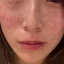 ピコスポット G MEDICAL ART クリニック 新宿院 DAY 0 サムネイル用