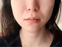 オリジオ Chloe Cheongdam Clinic （クロエチョンダムクリニック） AFTER サムネイル用