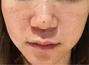 水光注射（ハリ・美肌） エトワールレジーナクリニック新宿院 DAY 0 サムネイル用