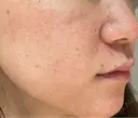 水光注射（ハリ・美肌） エトワールレジーナクリニック新宿院 DAY 0 サムネイル用