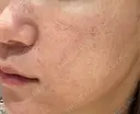 水光注射（ハリ・美肌） エトワールレジーナクリニック新宿院 DAY 0 サムネイル用