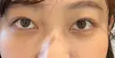 クマ治療 / 下まぶたたるみ取り / 下まぶたの脂肪取り 新宿美容外科ネビュラクリニック AFTER サムネイル用