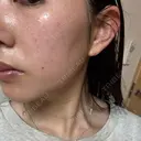 イオン導入 / 毛穴洗浄（ハイドラフェイシャルなど） / ルメッカ ルラ美容クリニック 岡山院 DAY 14 サムネイル用