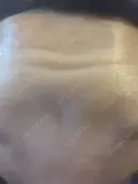 ボトックス（額） ルラライト美容クリニック 八王子院 DAY 3 サムネイル用