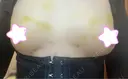 豊胸（脂肪注入） 銀座マイアミ美容外科 DAY 8 サムネイル用