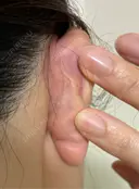 鼻尖形成（切開） / 鼻中隔延長（切開） / 軟骨移植 / 眉間プロテーゼ eクリニック 福岡院 DAY 55 サムネイル用