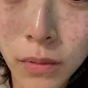 ピコスポット G MEDICAL ART クリニック 新宿院 DAY 1 サムネイル用