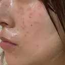 ピコスポット G MEDICAL ART クリニック 新宿院 DAY 1 サムネイル用