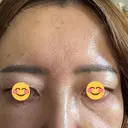 ボトックス（額） ルラ美容クリニック 郡山院 DAY 1 サムネイル用