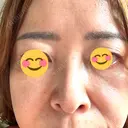 ボトックス（目尻） / 肌育注射（ジュベルックなど） ルラ美容クリニック 郡山院 DAY 9 サムネイル用
