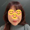 糸リフト / ボトックス（あご） / ヒアルロン酸注入（唇） / ボトックス（眉間） / ボトックス（目尻） eクリニック 那覇院 AFTER サムネイル用