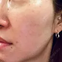 光治療（フォトフェイシャルなど） しんゆり美容健康クリニック AFTER サムネイル用