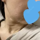 ニードルRF（ポテンツァなど） GRACY TOKYO CLINIC【グレイシートウキョウクリニック】 DAY 0 サムネイル用