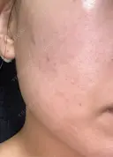 ピーリング（ハリ・ツヤ） / ルメッカ 大美会クリニック 天王寺院 AFTER サムネイル用