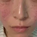 ピコスポット G MEDICAL ART クリニック 新宿院 DAY 2 サムネイル用