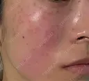 ピコスポット G MEDICAL ART クリニック 新宿院 DAY 2 サムネイル用