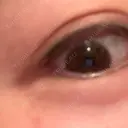 ヒアルロン酸注入（涙袋） / ヒアルロン酸注入（こめかみ） DMTC CLINIC 日本橋院 DAY 130 サムネイル用