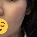 ピーリング（ハリ・ツヤ） / ルメッカ ルラ美容クリニック 広島院 DAY 6 サムネイル用