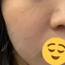 ピーリング（ハリ・ツヤ） / ルメッカ ルラ美容クリニック 広島院 AFTER サムネイル用