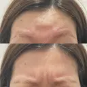 ワキ汗治療（ボトックス） / ボトックス（眉間） J CLINIC DAY 0 サムネイル用