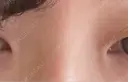その他（目元） BRIGHTS beauty clinic DAY 3 サムネイル用
