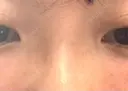 その他（目元） BRIGHTS beauty clinic DAY 11 サムネイル用